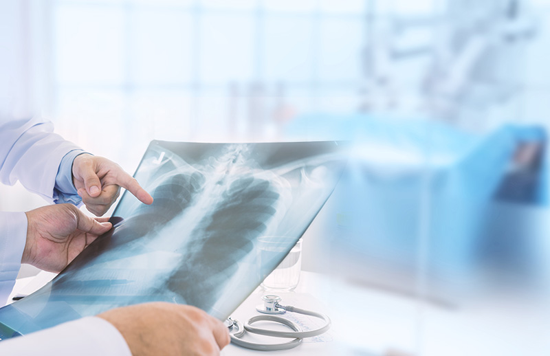 Akciğer Zarı Kanseri Nedir?