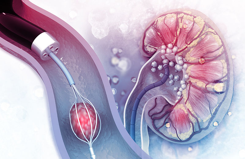 Laparoskopik (Kapalı) Davydoy Neovajen