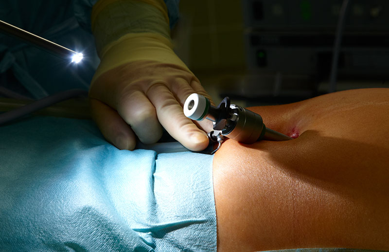 Laparoskopik (Kapalı) İstmosel Onarımı