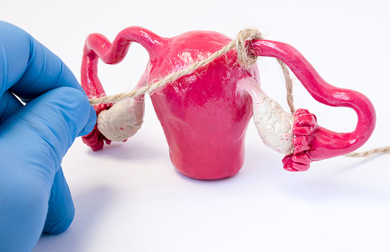 Laparoskopik (Kapalı) Tüp Ligasyonu